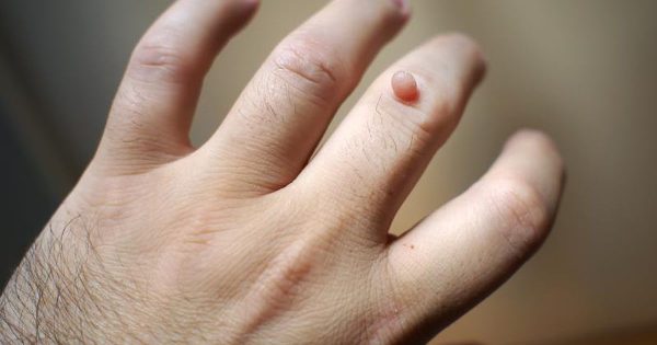 Home Remedies to Get Rid of Warts